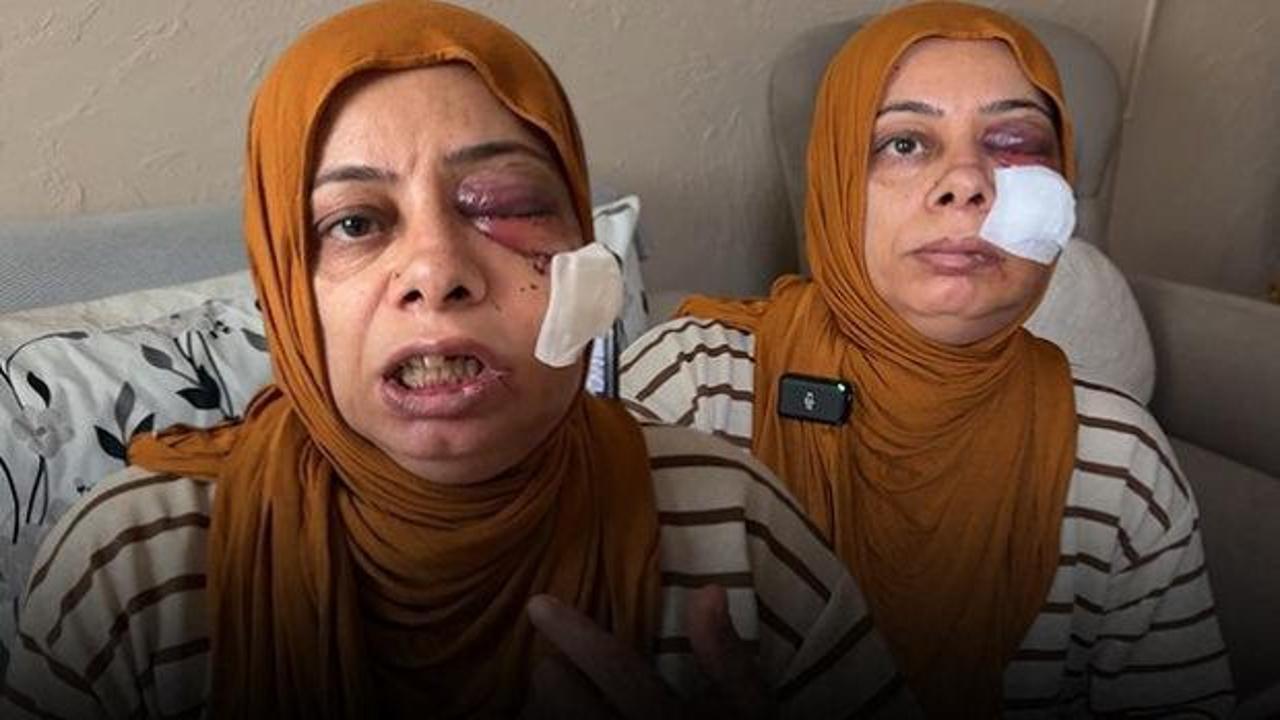 Hatay'da korkun&ccedil; kaza: Dişleri kırıldı, y&uuml;z&uuml;ne 14 dikiş atıldı 