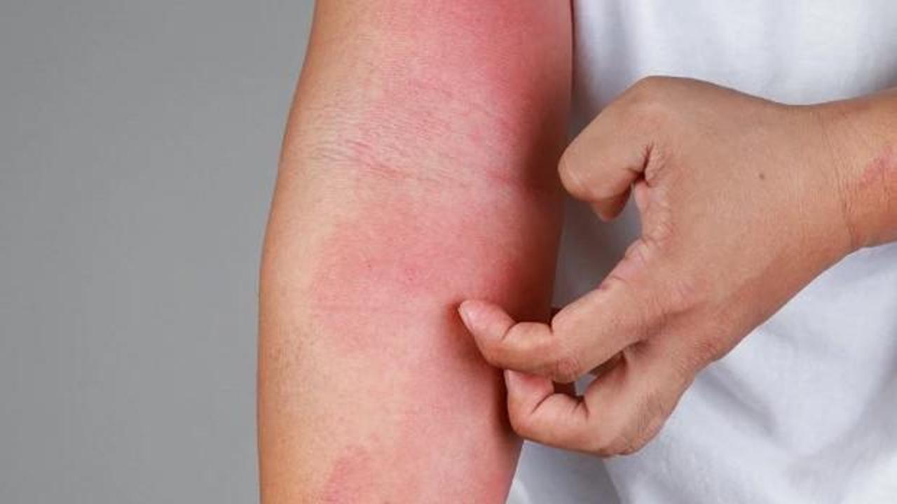 İstanbul'da büyük tehlike! Kuduz vakaları artıyor! En çok görülen ilçeler belli oldu