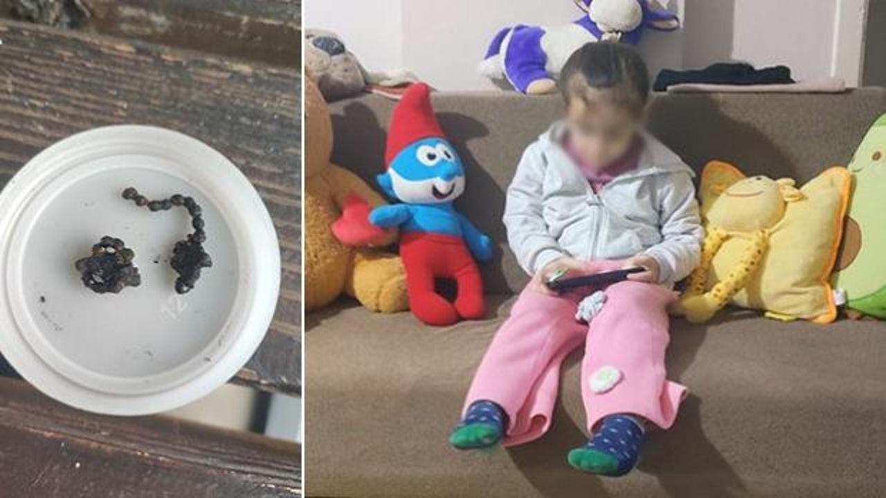 5 yaşındaki &ccedil;ocuğun burnundan &ccedil;ıkan şoke etti! 2 yıl sonra fark edildi 