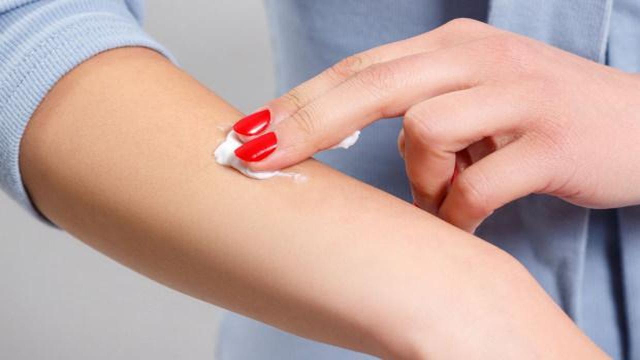 B&ouml;cek ısırığı kremi: Bu yaz kaşıntıya son