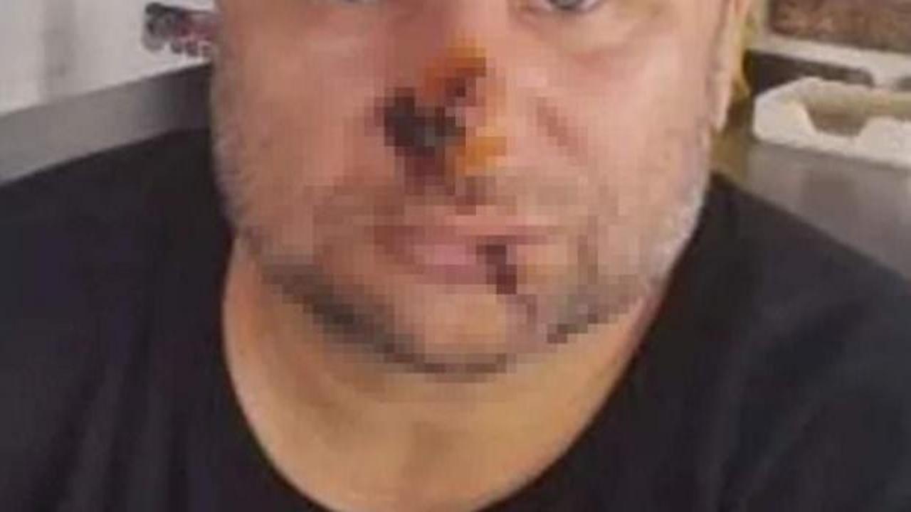 &Uuml;nl&uuml; şarkıcının y&uuml;z&uuml; &ccedil;&uuml;r&uuml;meye başladı! Ent&uuml;be edildi...