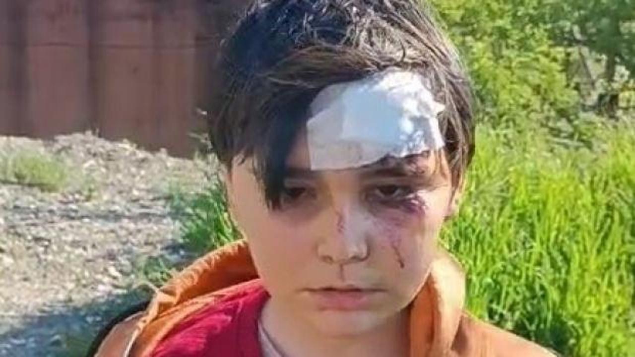 K&uuml;tahya'da başıboş k&ouml;pek dehşeti! 2 &ccedil;ocuk saldırıya uğradı