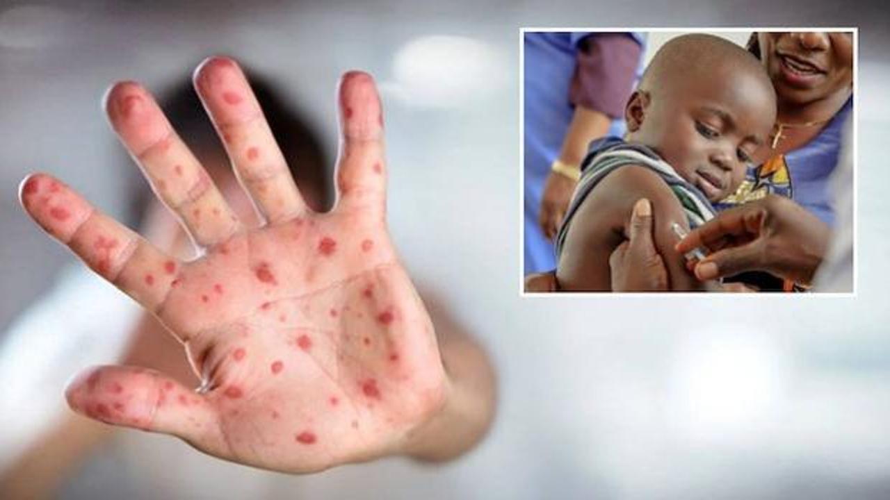 Nijerya'da kızamık salgını! &Ccedil;ok sayıda 15 &ccedil;ocuk &ouml;ld&uuml;