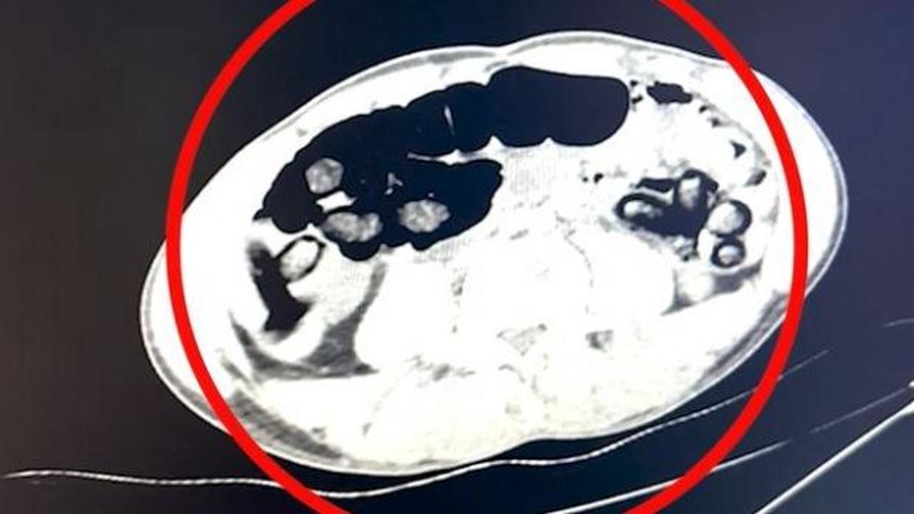 Batman'da 4 şüphelinin midesinde çıkan şoke etti