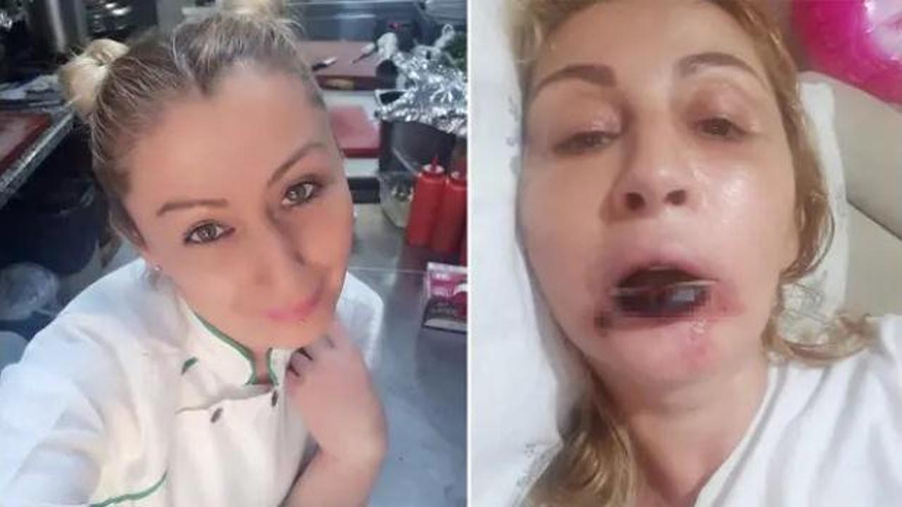 Yaptırdığı işlem sonrası dudağı &ccedil;&uuml;r&uuml;d&uuml;! 7 yıldır kabusu yaşıyor...