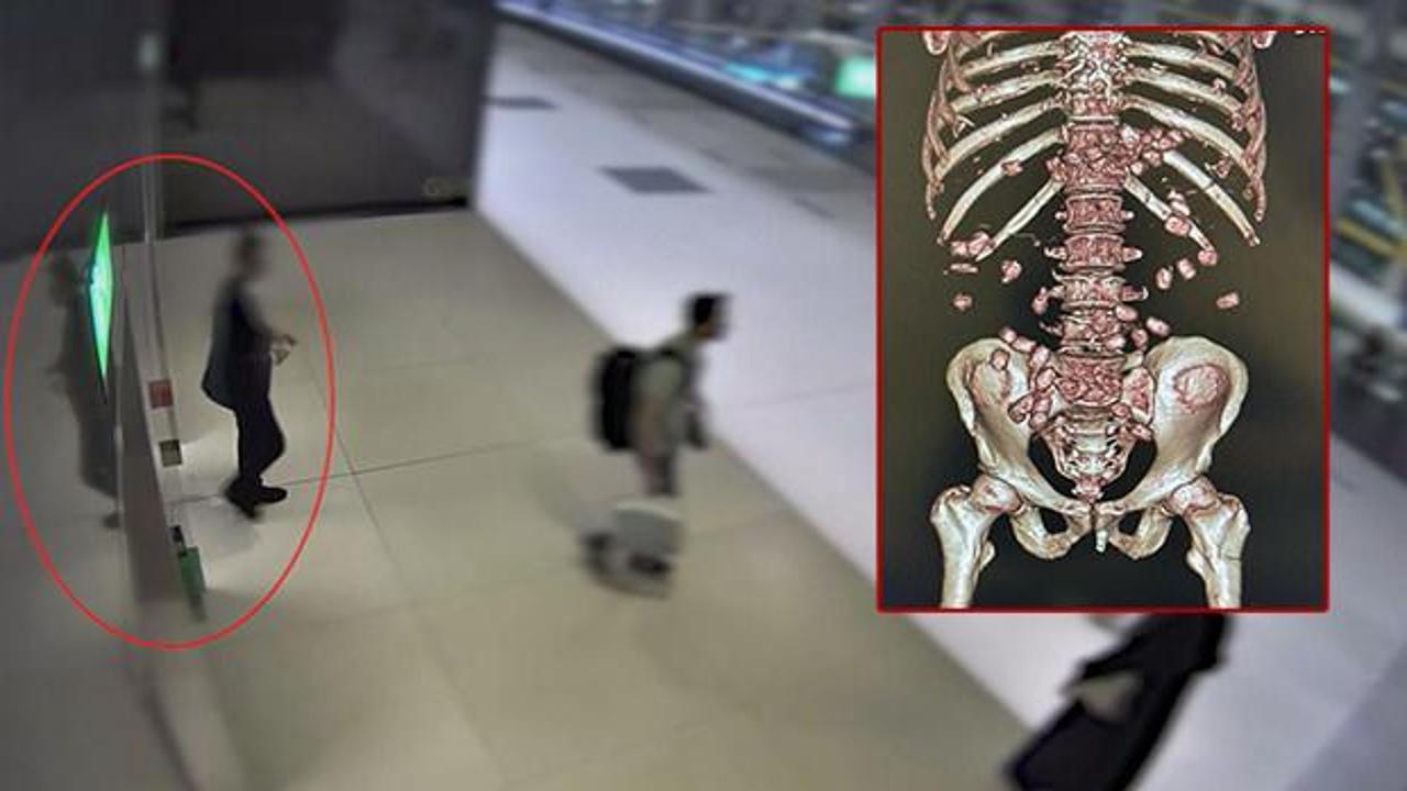 Midesinden uyuşturucu kapsülleri çıkan kadın