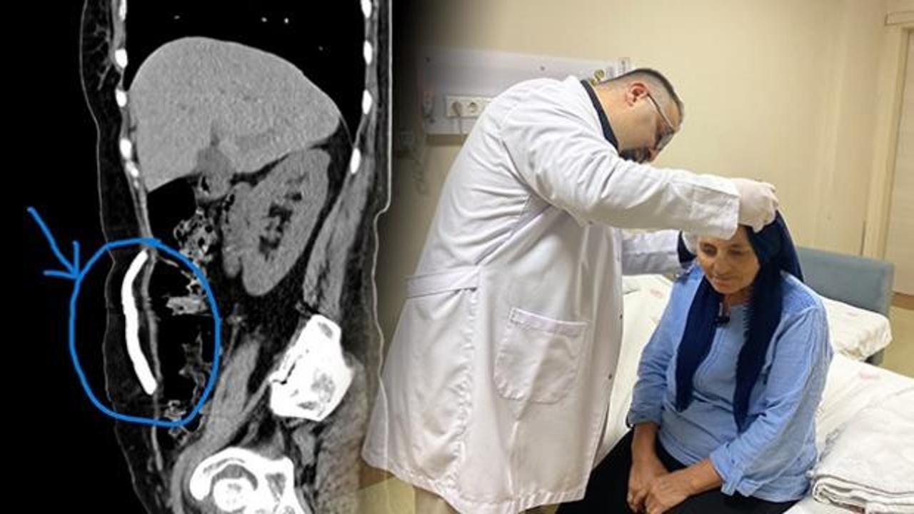 Dikkat &ccedil;eken vaka! Kafatasından alıp 8 ay karnında muhafaza ettiler 