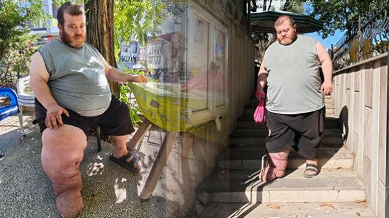 Kazım 4 yıldır bu illet hastalıkla m&uuml;cadele ediyor! Doktorlar tek &ccedil;are var dedi 