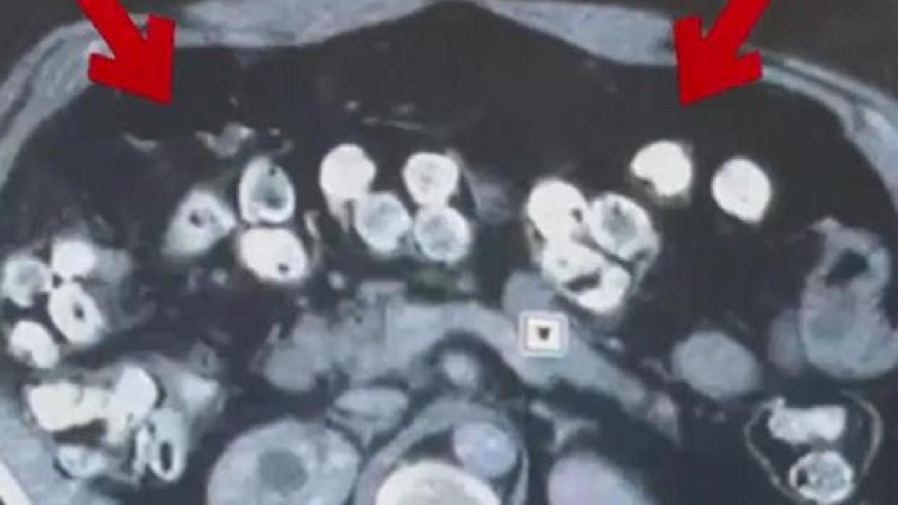 2 kilo 675 gram Afyon sakızı yuttuğu tespit edilen 3 ş&uuml;pheli tutuklandı