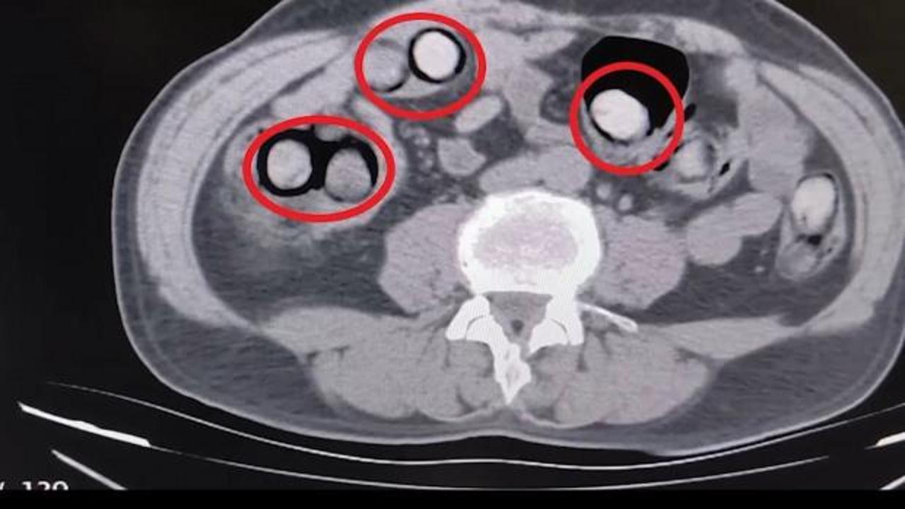 Midesinden &ccedil;ıkan şoke etti! 758 gram uyuşturucuyla yakalandı