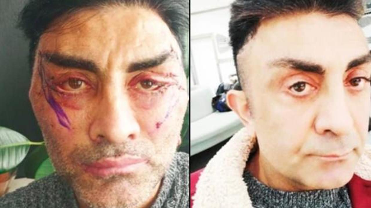 Gen&ccedil;leşmek istedi, hayatı kabusa d&ouml;nd&uuml;! 4 ameliyat oldu, g&ouml;zlerini kapatamıyor