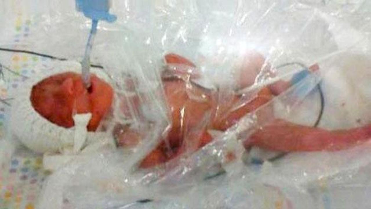 54 gram doğan bebek bakın nasıl hayata tutundu