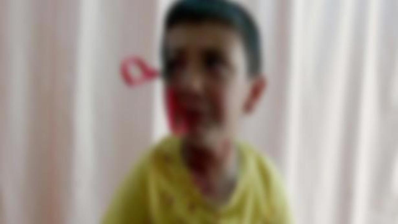 5 yaşındaki Can'ın gözüne makas saplandı