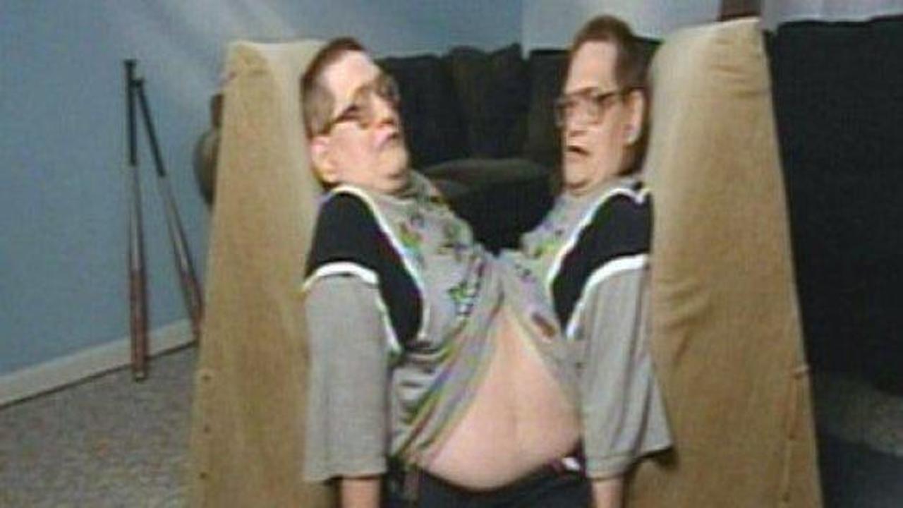 62 yıldır aynı bedende yaşıyorlar 