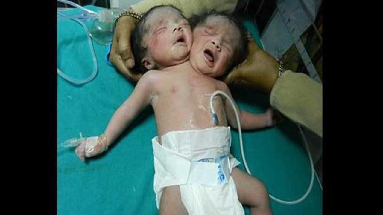 Çift başlı bebek dünyayı şoke etti!