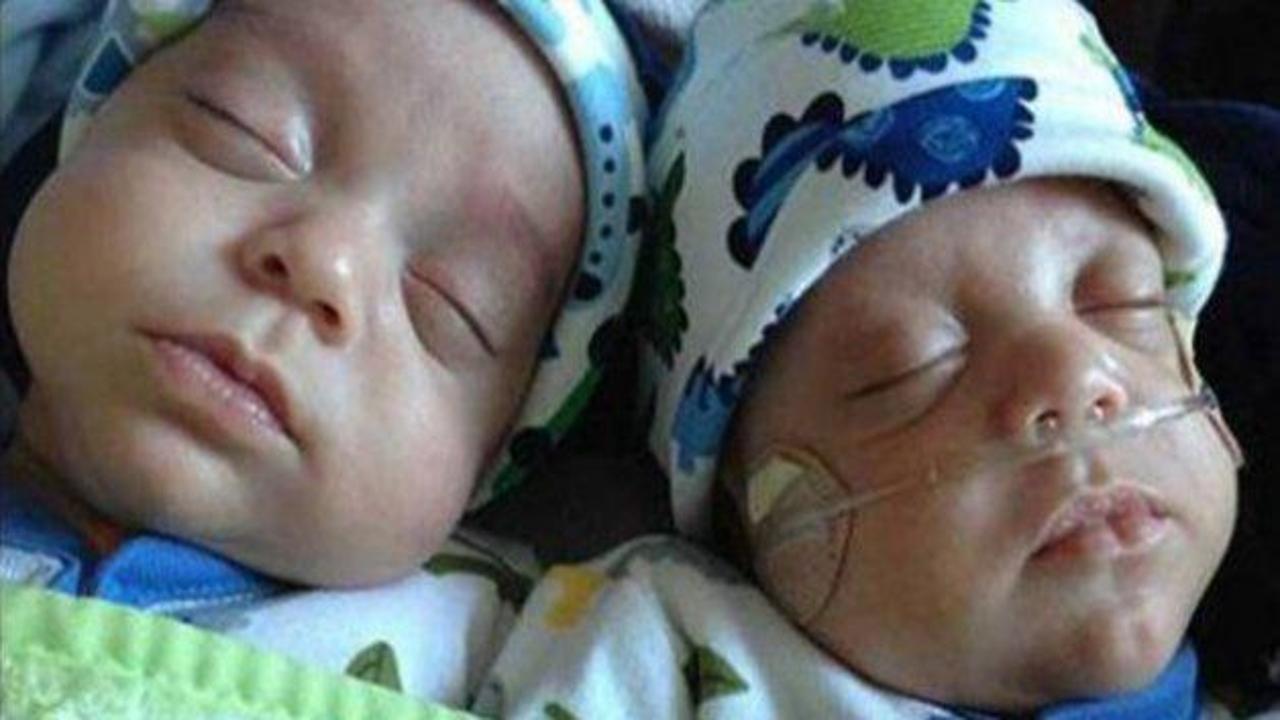 İkizlerden biri 39 gün sonra doğdu