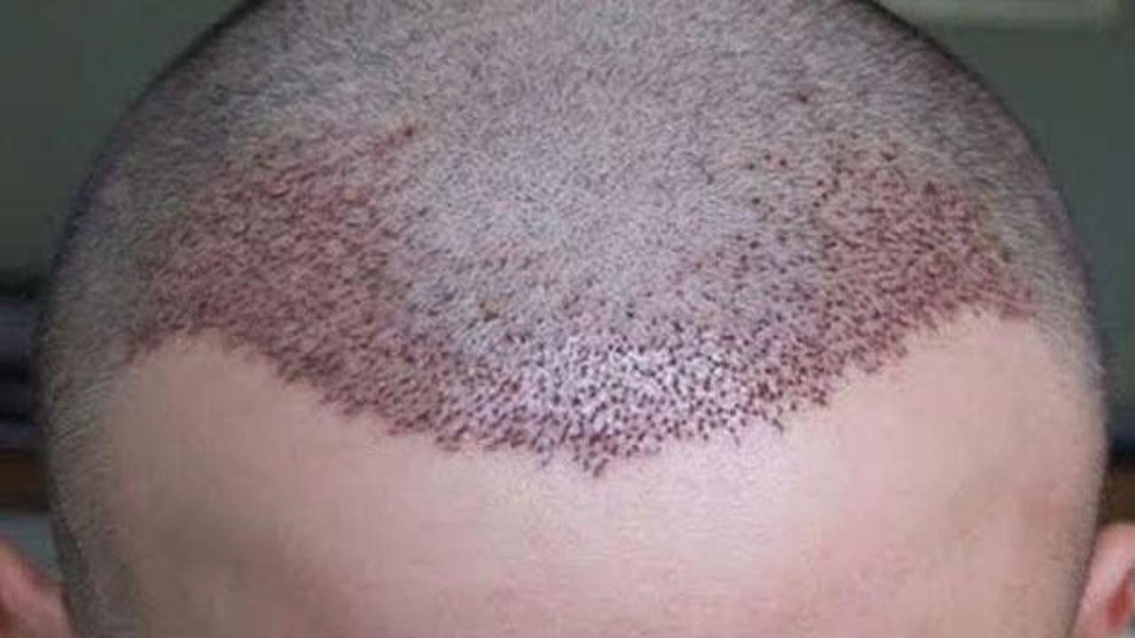 Sağlıksız saç ekimi ölüme neden olabiliyor