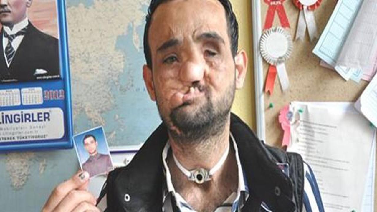 Y&uuml;z nakli yapılan Recep Sert uyandırılmaya başladı