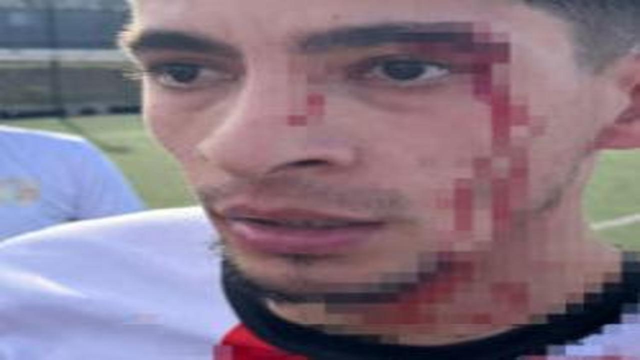Yeşil sahada kan gövdeyi götürdü: 3 futbolcu hastanelik oldu