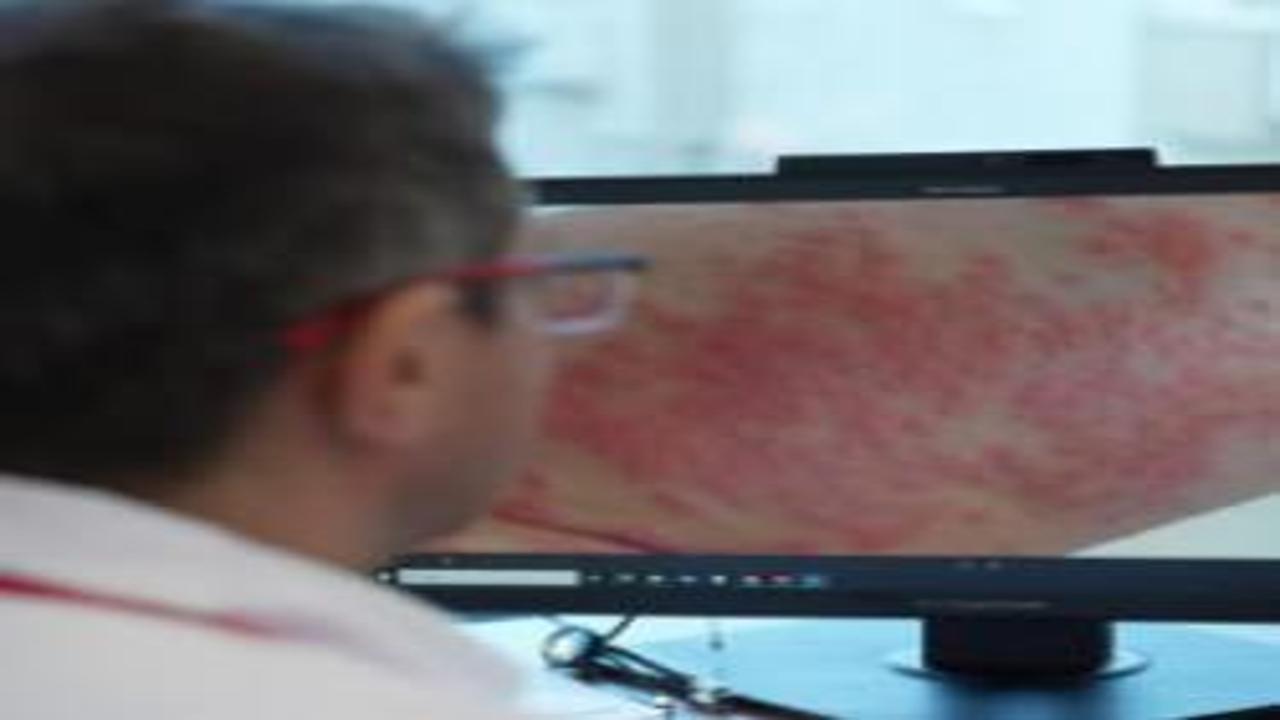 Uzmanından uyarı: Egzamalı çocuğa ezbere diyet yaptırmayın