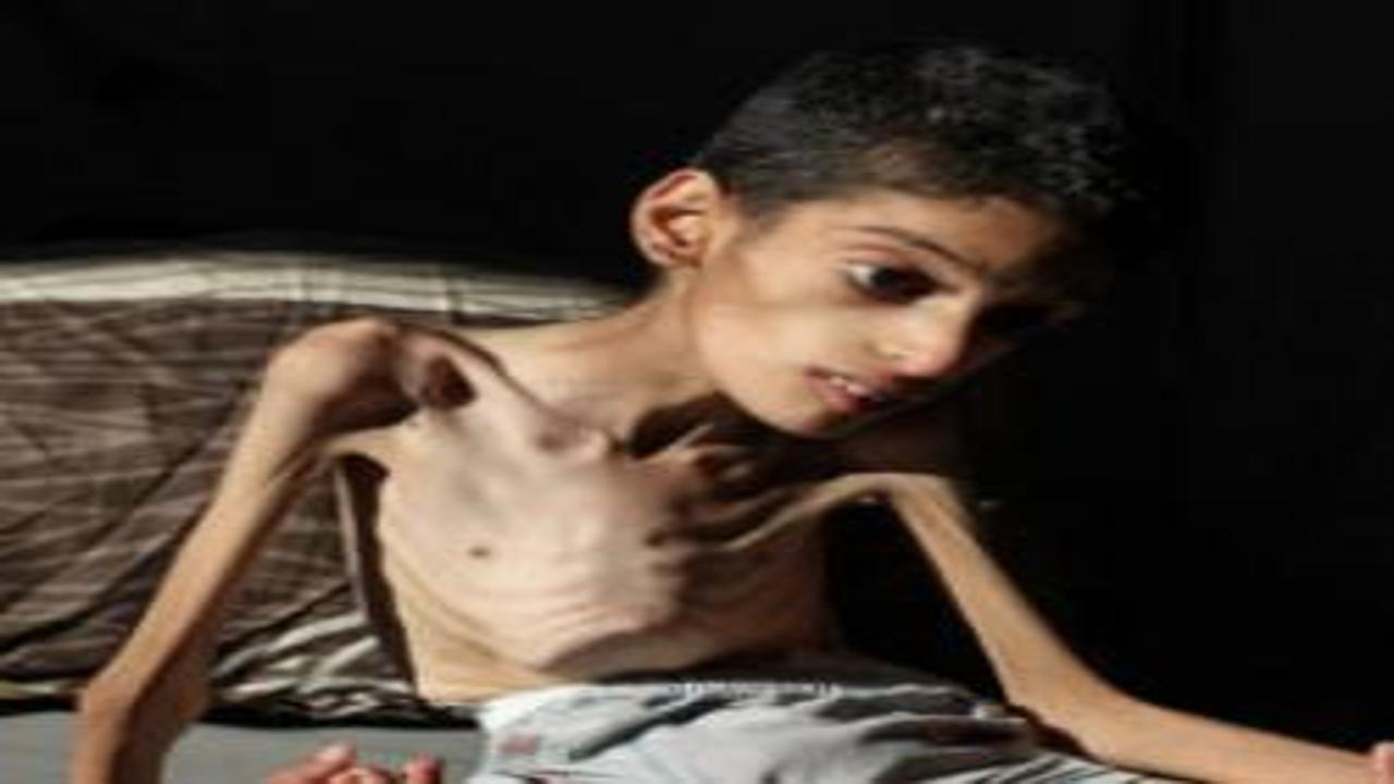 16 yaşındaki Gazzeli İbrahim 7,5 kiloya düştü