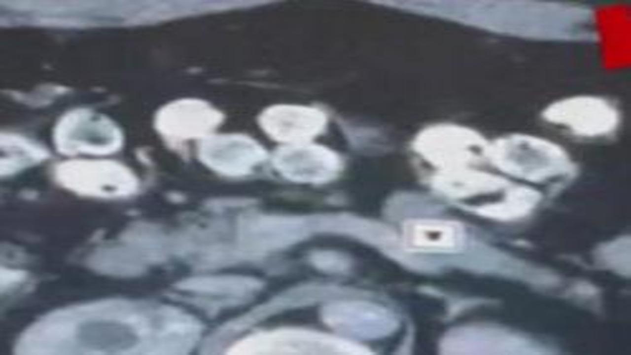 2 kilo 675 gram Afyon sakızı yuttuğu tespit edilen 3 şüpheli tutuklandı