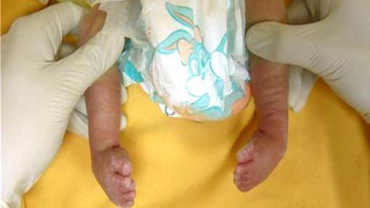 5,5 aylık doğan bebek bir yaşına bastı