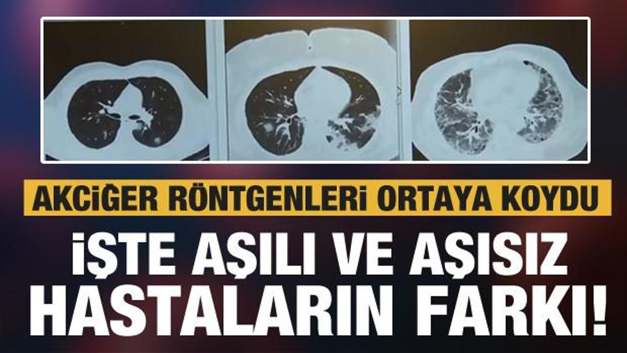 Aşılı ve aşısız hastaların farkı röntgen filminde! İşte üç Kovid hastasının akciğerleri