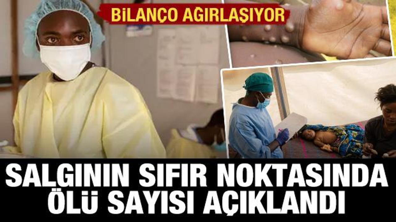 Kongo Demokratik Cumhuriyeti'nde M çiçeği bilançosu artıyor