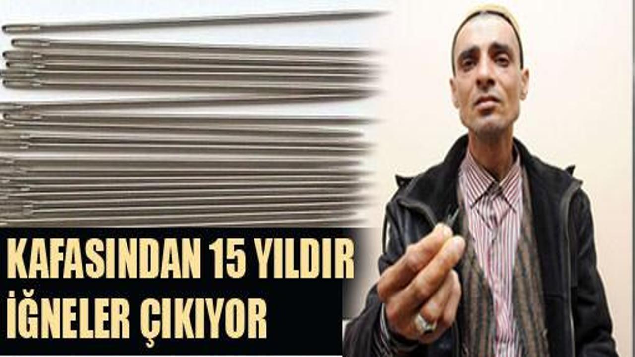 Kafasından 15 yıldır iğne çıkıyor