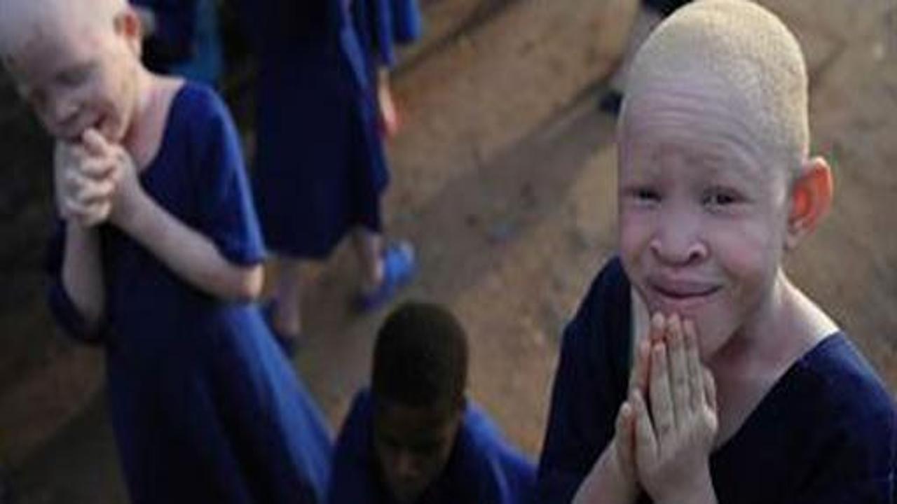 Kara kıta Afrika'nın albino vahşeti