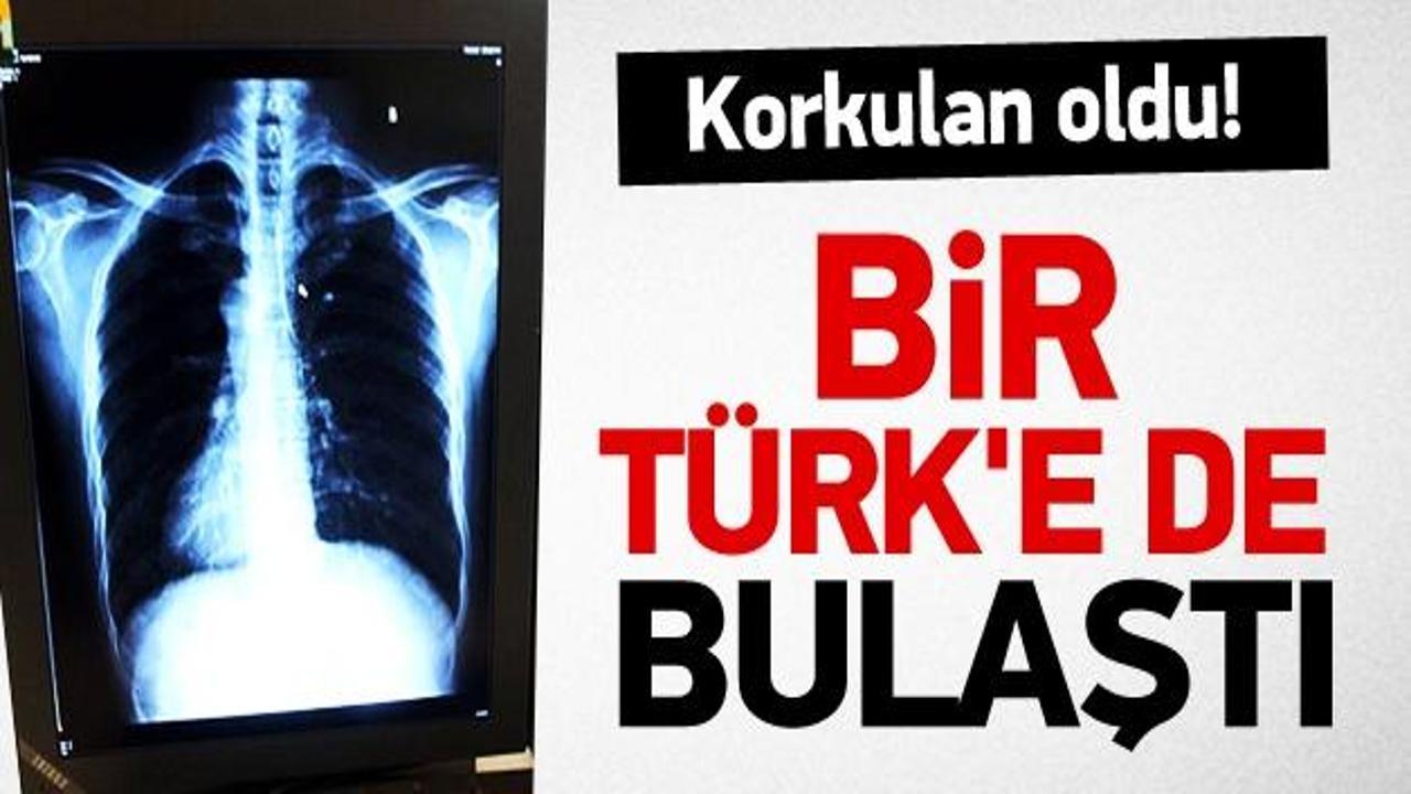 Katil virüs bir Türk'e de bulaştı