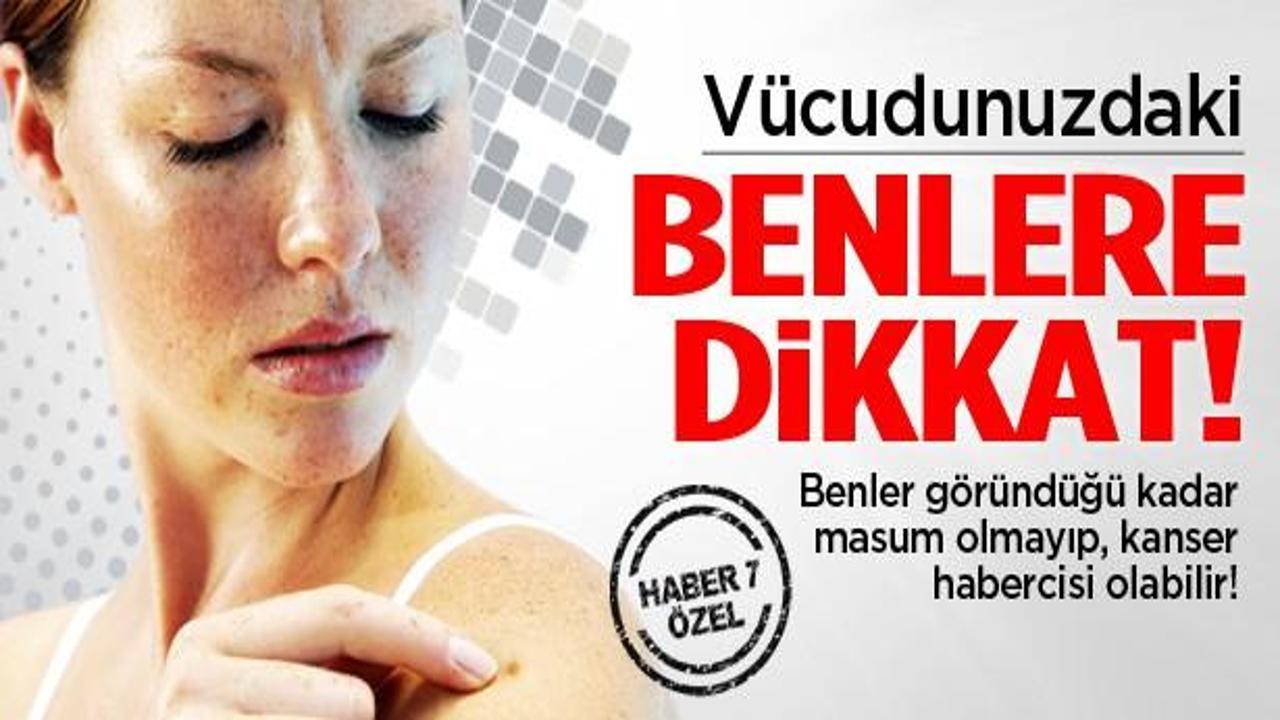 Vücuttaki benler kanserin habercisi olabilir!