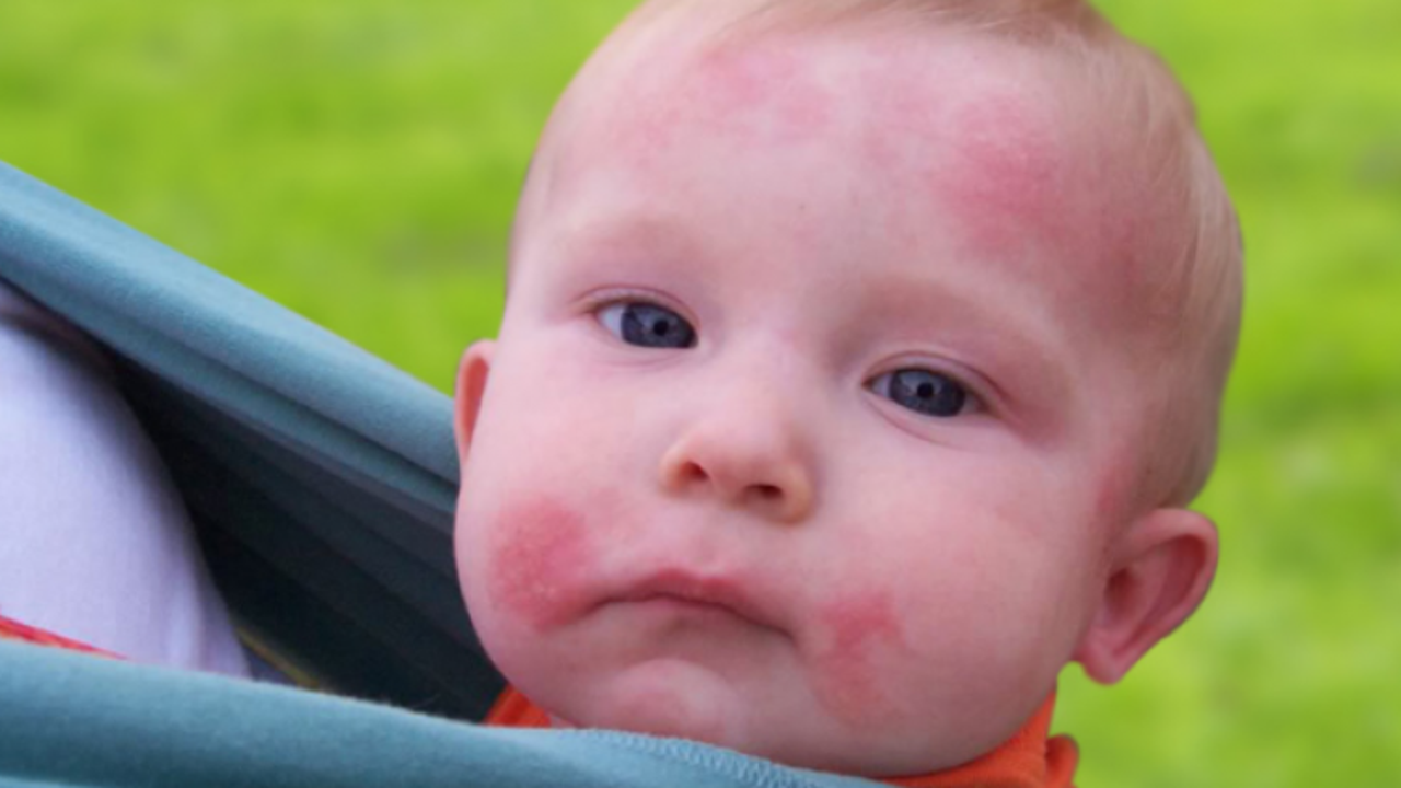 Аллергические пятна на лице у ребенка.