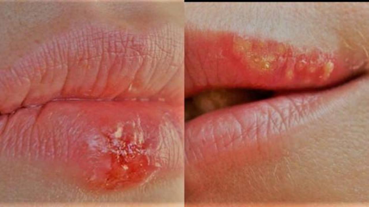 The fastest solution to recurring cold sores! Is herpes on the lips