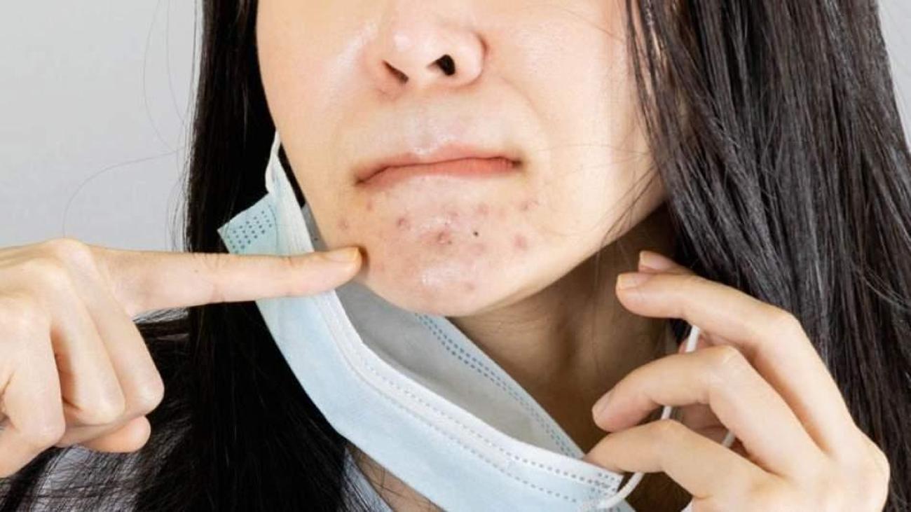 Maske Sivilce Mi Yapiyor Maskne Nedir Ve Neden Olur Maskne Ile Nasil Basa Cikilir Guzellik Haberleri