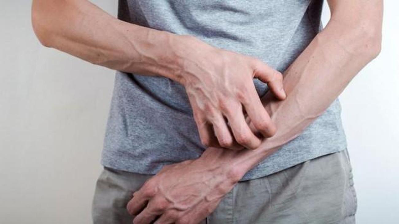 Uyuz Hastaliginda Dogru Bilinen Yanlislar Bu Belirtilere Dikkat Saglik Haberleri