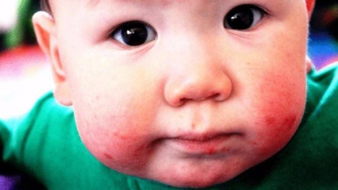 Bebeklerde ağız yaraları nasıl geçer? Bebeklikte ve çocuklarda ağız içi