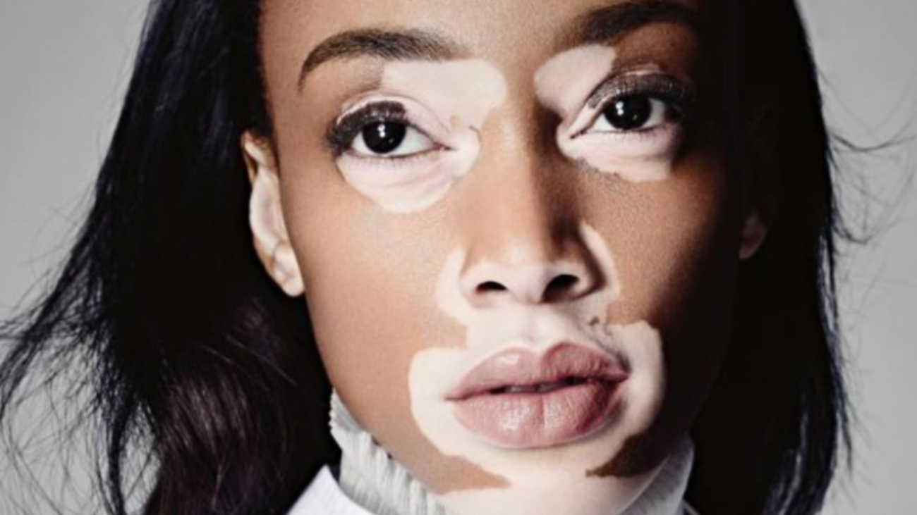 Vitiligo Hastalığı Nedir Bitkisel Tedavi Yöntemleri Sağlık Haberleri 2922