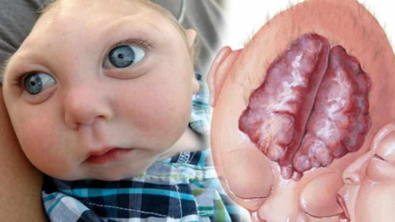 Anensefali nedir? Bebek ve çocuklarda Anensefali