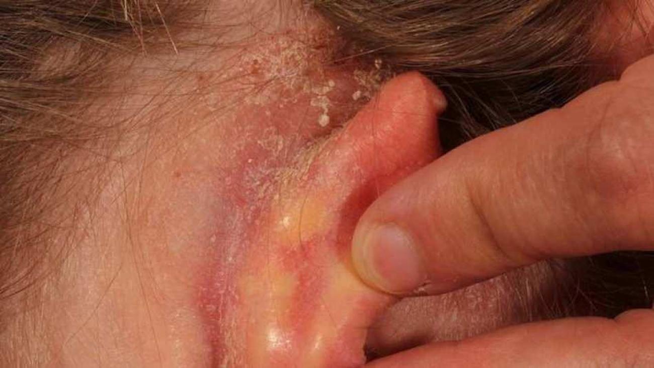 does psoriasis always itch does psoriasis always itch