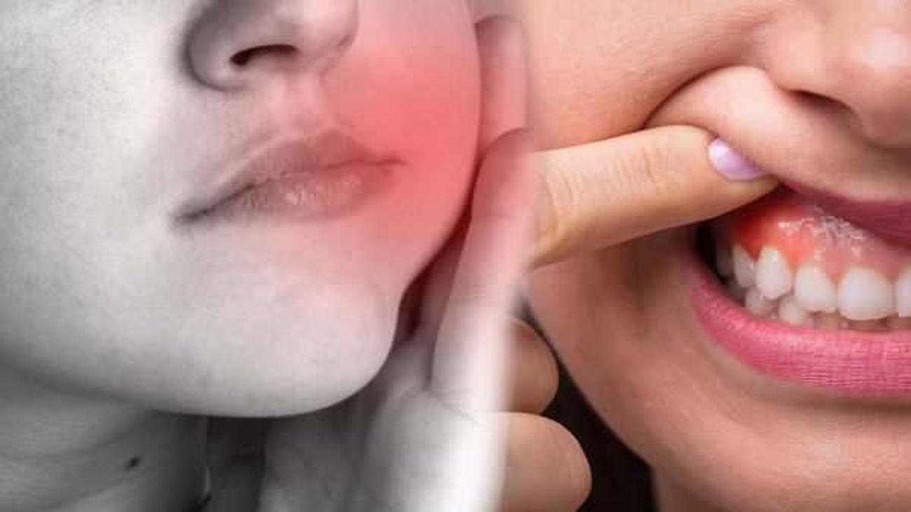Diş apsesi neden olur? Belirtileri nelerdir ve kaç günde geçer? Diş