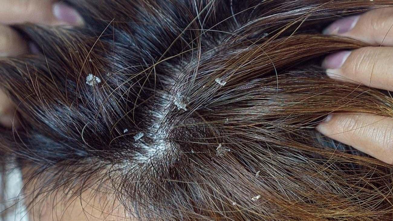 Saç derisi kaşıntısı nasıl geçer? Saç derisinde kaşıntı neden olur ve
