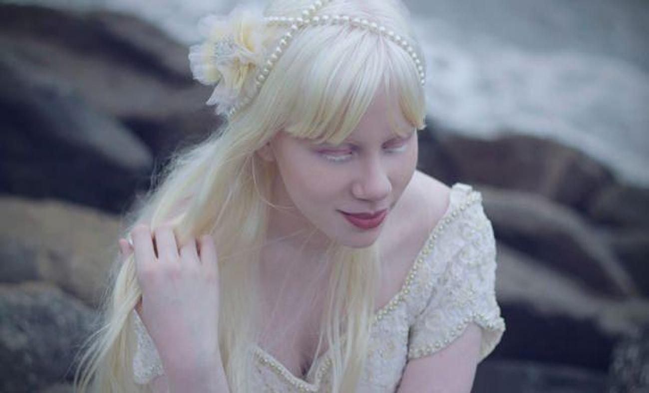 Albino Hastaligi Nedir Tedavisi Var Midir Saglik Haberleri