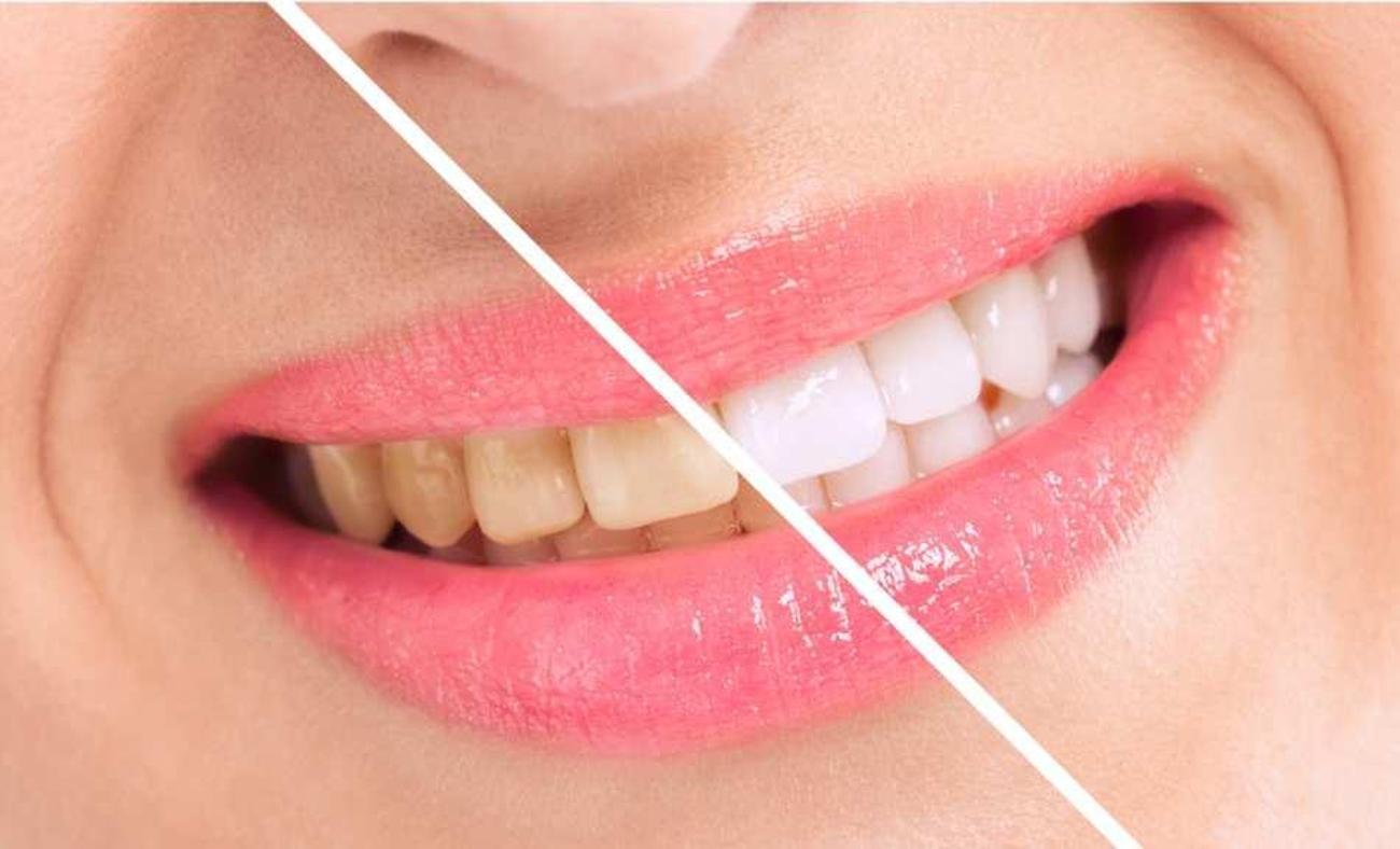 Beyaz dişler için öneriler nelerdir? Evde doğal yolla yapılan diş beyazlatma kürü...