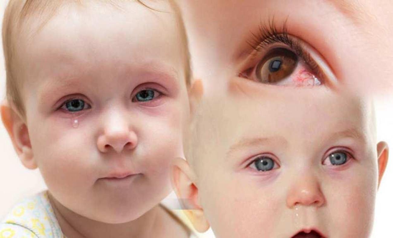 Bebeklerin gözleri neden kanlanır? Yeni doğan bebekte göz kanlanması nasıl geçer?