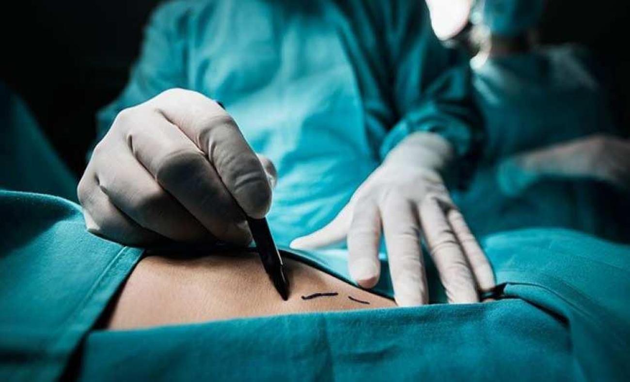 Liposuction Operasyonu nedir ve ne işe yarar? Liposakşın nasıl yapılır?