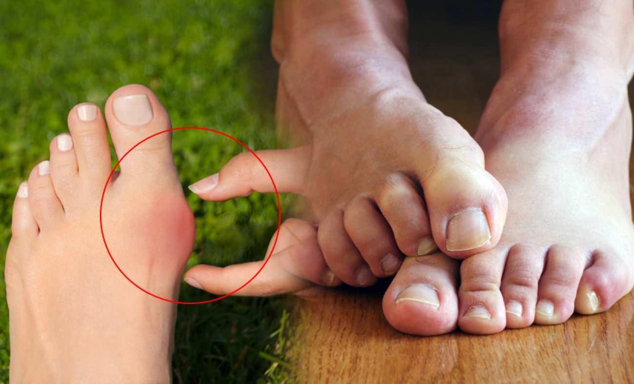 Taraklı ayak nedir ve taraklı ayak nasıl tedavi edilir? Halluks Valgus nasıl incelir?