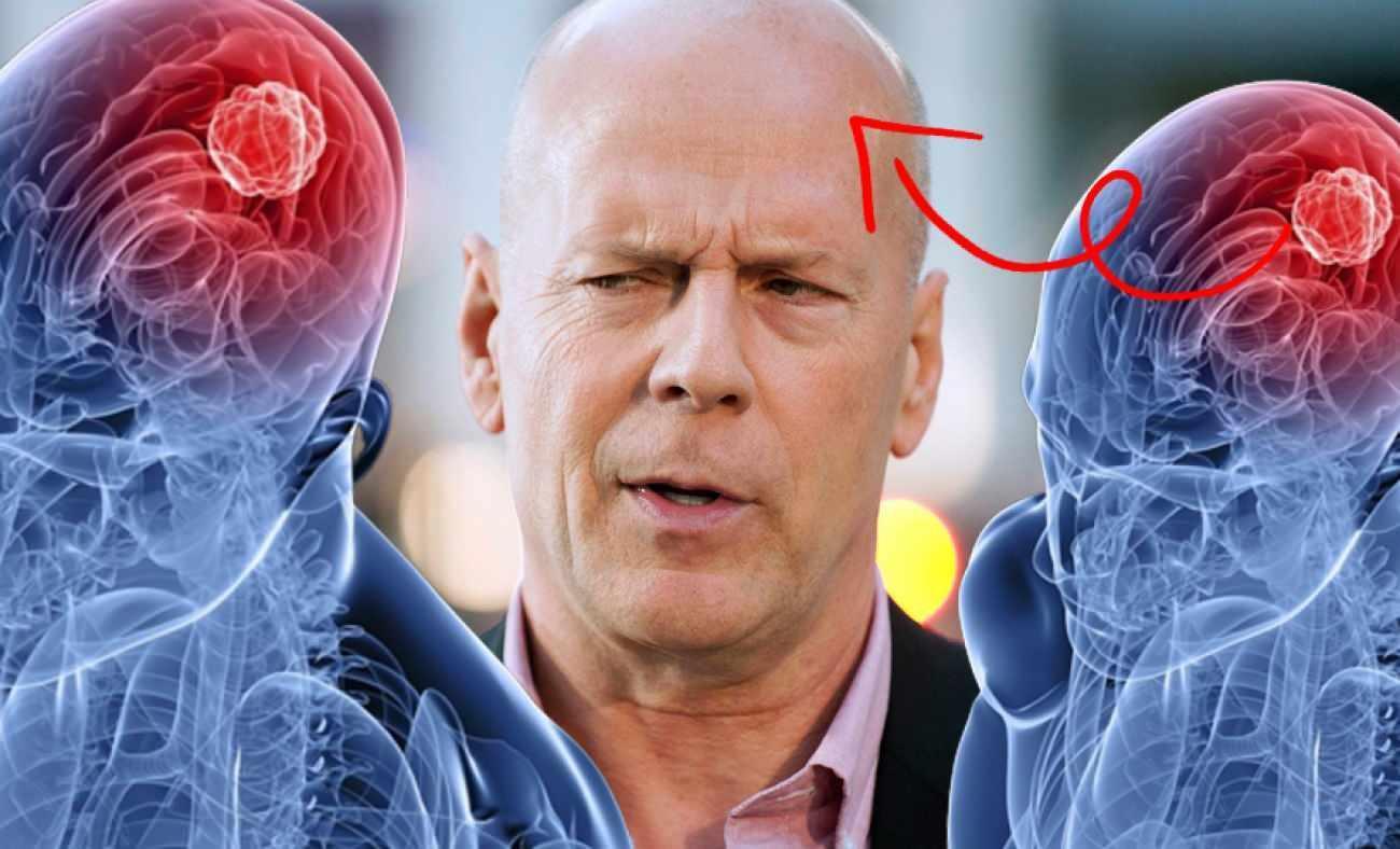 Bruce Willis'e oyunculuğu bıraktıran Afazi hastalığı nedir? Afazinin belirtileri nelerdir?