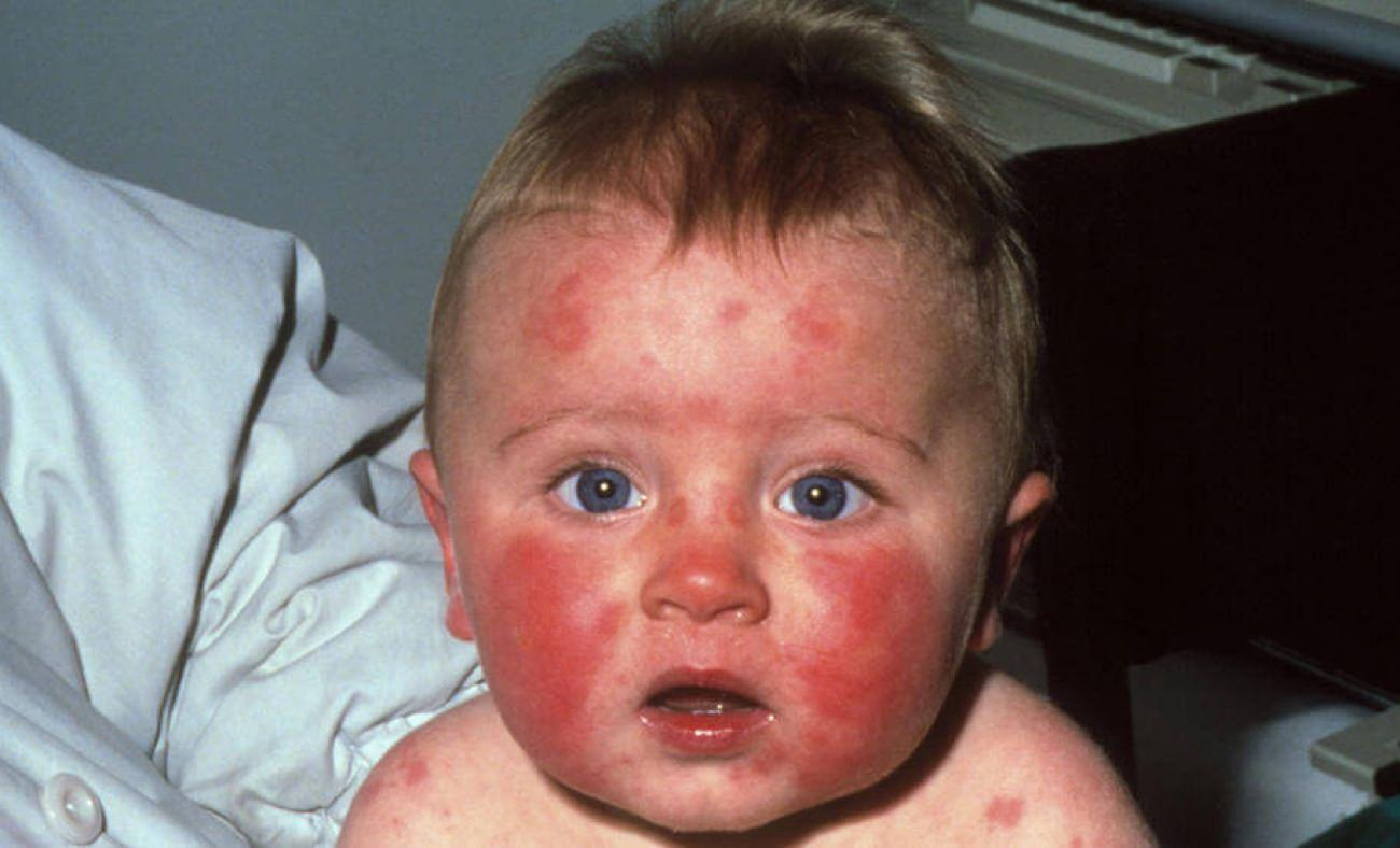 Parvovirüs B19 nedir? Çocuklarda "Beşinci hastalık" nasıl bulaşır? Belirtileri ve tedavisi...